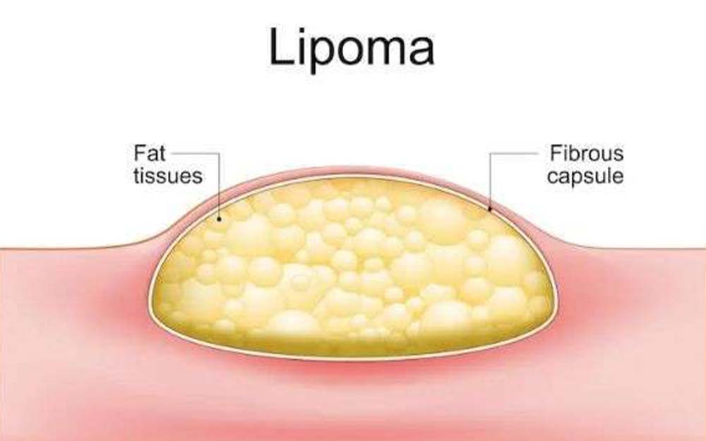 Importance of Early Detection and Treatment of  Lipomas